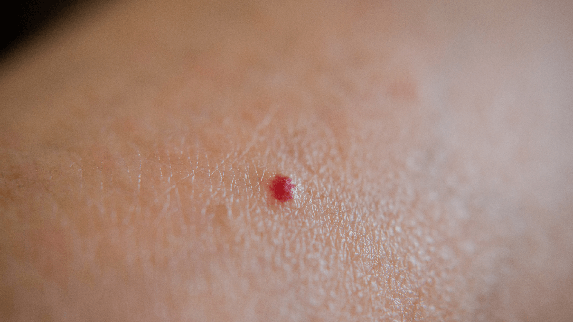 Cherry Angioma Symptoms and Treatments