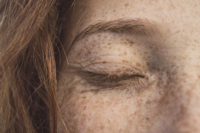 Do Acne Scars Go Away Over Time?